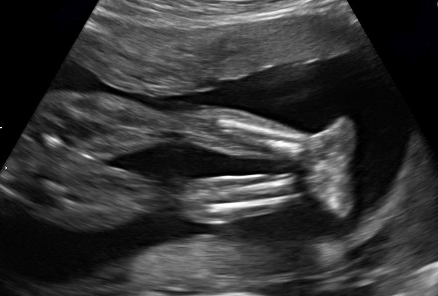 3rd Trimester Ultrasound of Legs