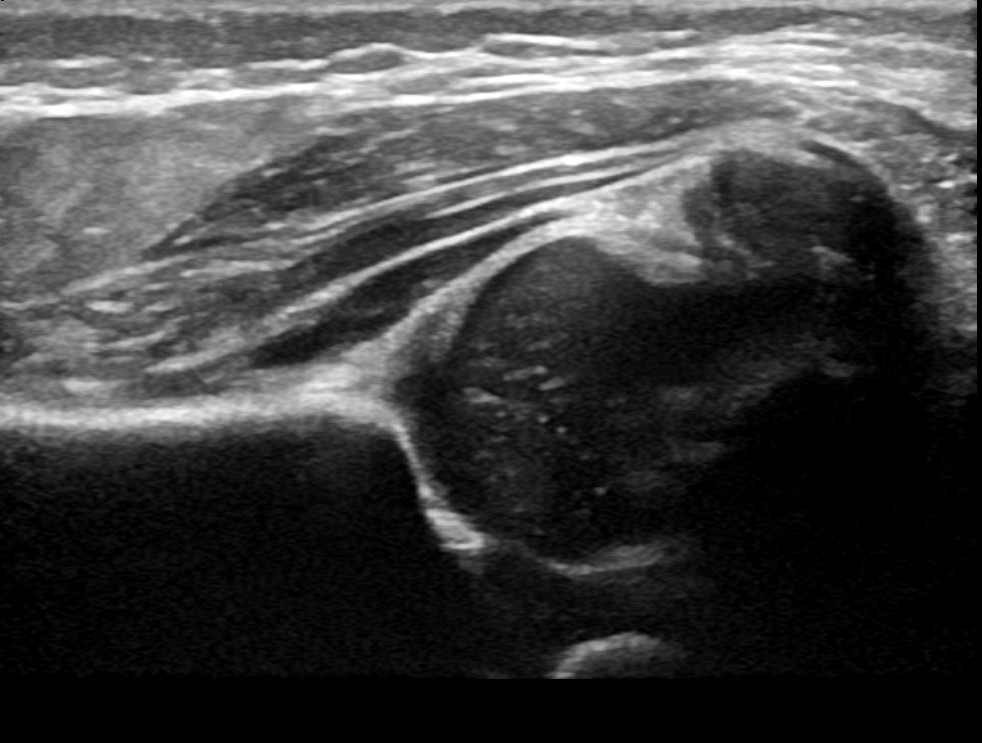 Dysplasia of the hip parameter ultrasound image