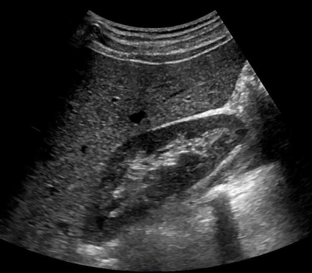 Extended focused assessment with sonography for trauma (eFAST) ultrasound image