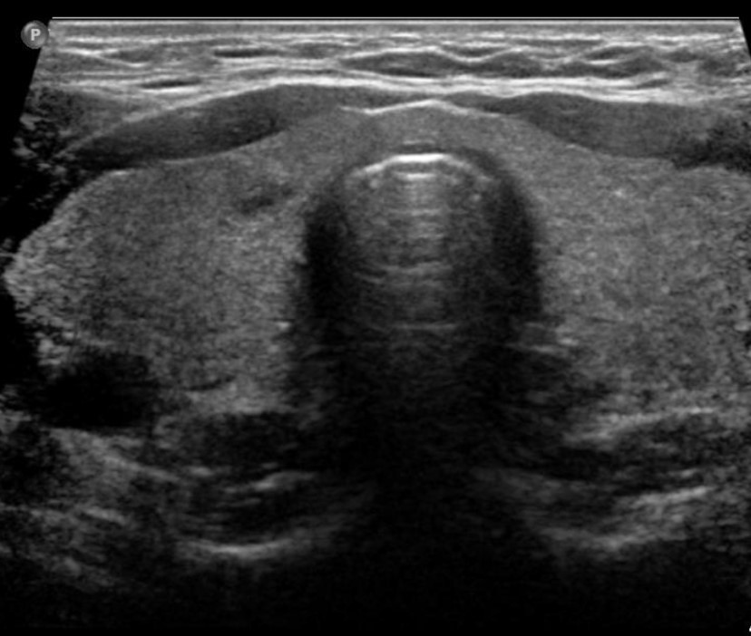 Extracranial ultrasound image