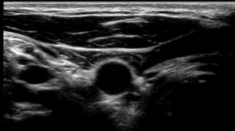 Extracranial ultrasound image