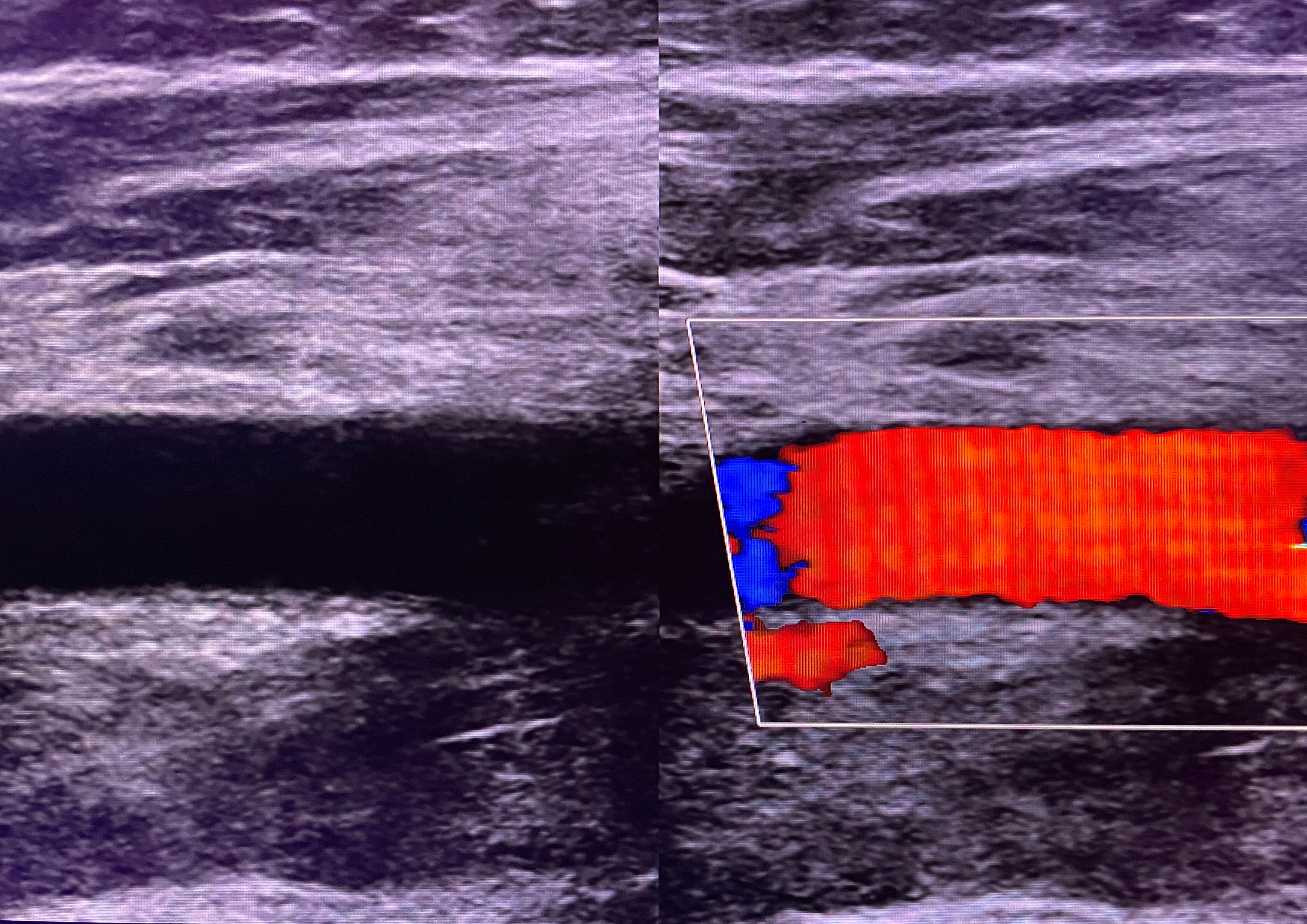 Extremity artery parameter ultrasound image