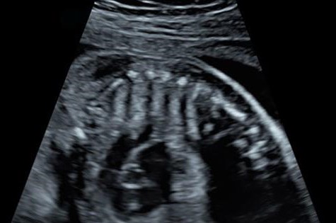 Fetal echocardiography parameter ultrasound image