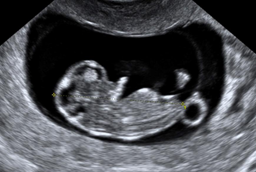 First trimester obstetric ultrasound image