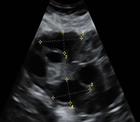 Follicular ultrasound image