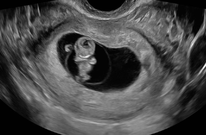 Limited obstetric ultrasound parameter image