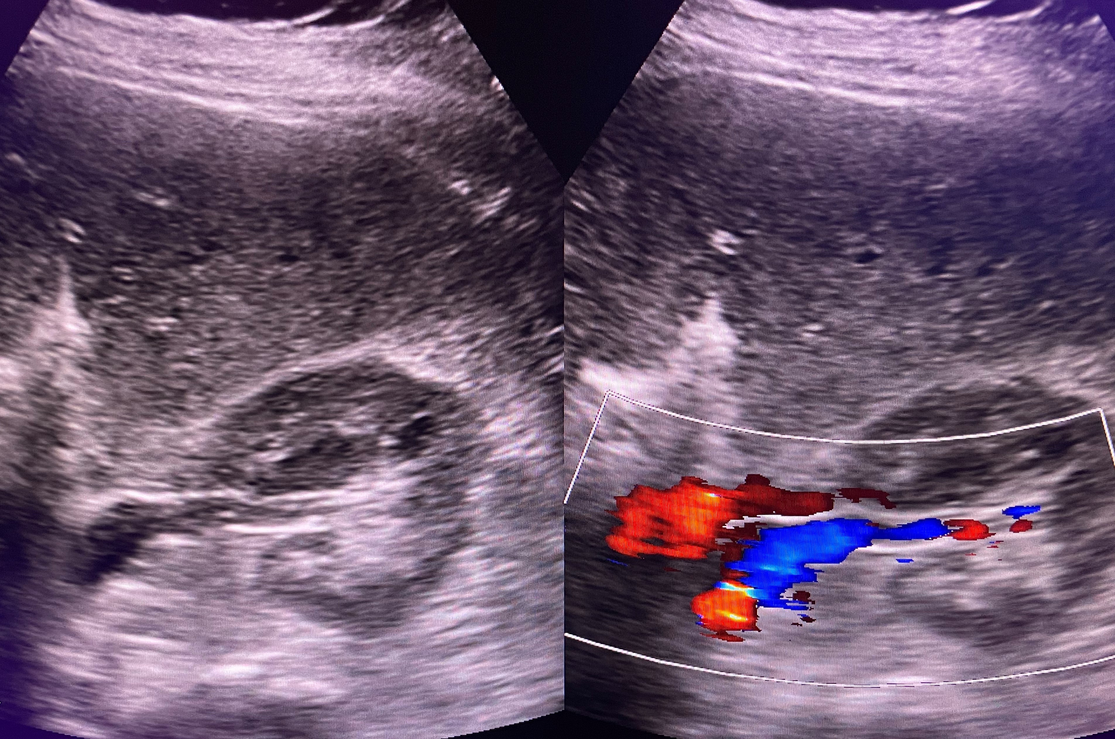 Native renal kidney parameter ultrasound image