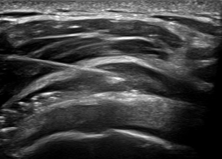 Ultrasound-guided needle injection into shoulder bursa image