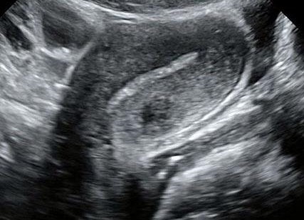 Pelvic ultrasound image