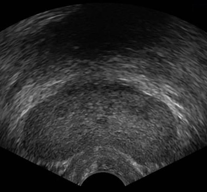 Prostate ultrasound parameter image