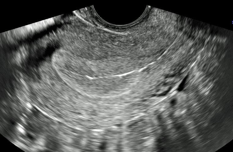 Reproductive endocrinology and infertility (REI) ultrasound image
