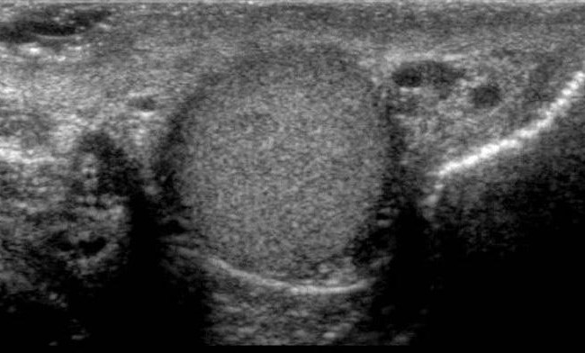 Scrotal ultrasound parameter image