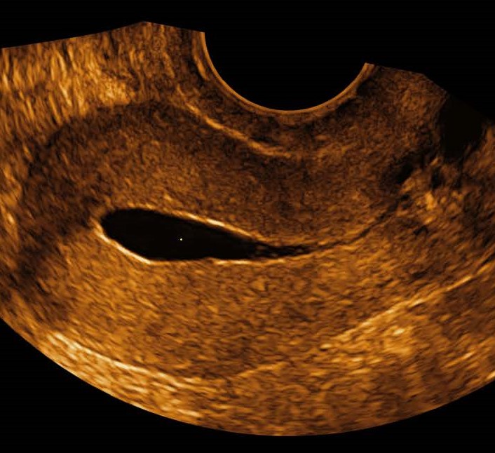 Sonohysterography parameter ultrasound image