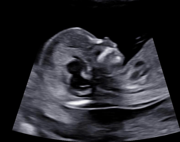 Ultrasound Scan 1st trimester