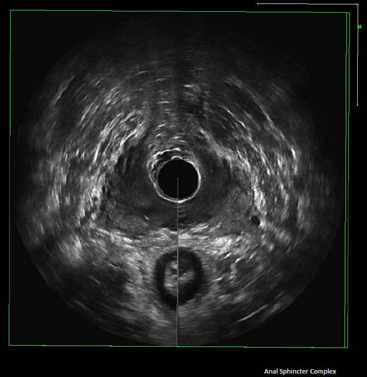 Urogynecology parameter ultrasound image